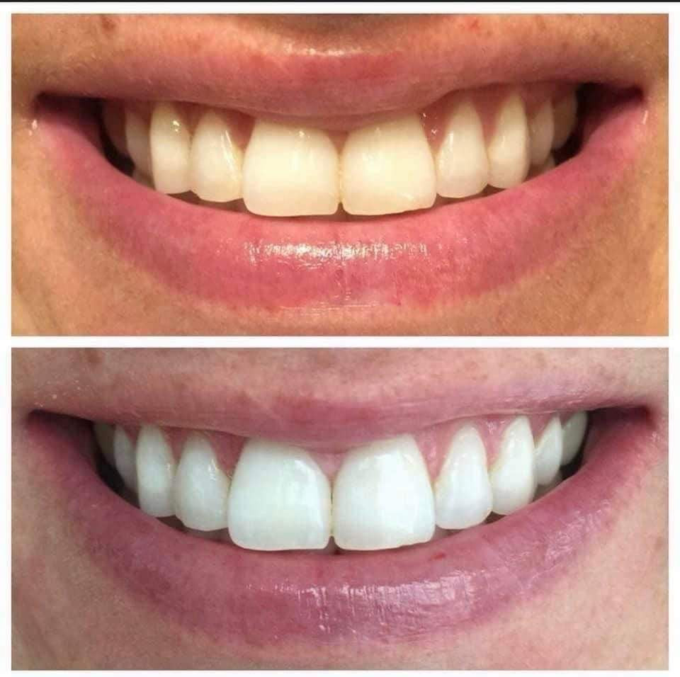 Whitening Toothpaste